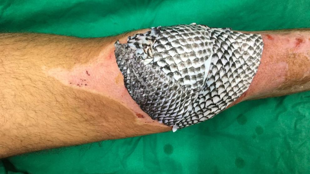 La piel de la tilapia es aplicada sobre las quemaduras (Gentileza RT).