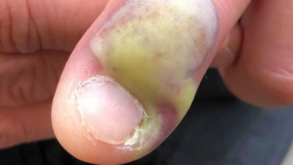 Se le pudrió un dedo por comerse mucho las uñas y casi muere. (Facebook: Karen Peat)