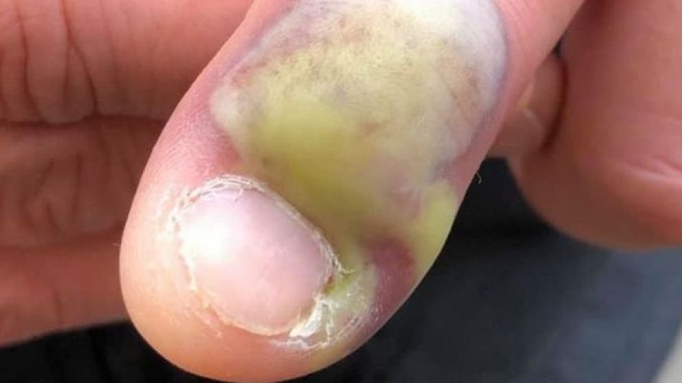 Se le pudrió un dedo por comerse mucho las uñas y casi muere. (Facebook: Karen Peat)