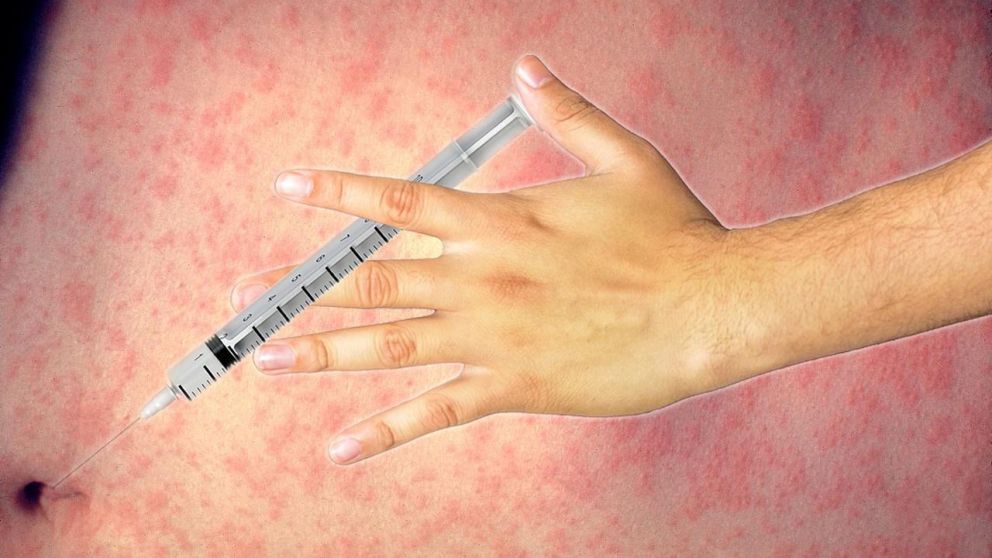 M�s de un centenar de casos de sarampi�n en Buenos Aires