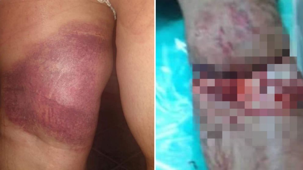 Las heridas que sufrió la pareja tras el incidente del tobogán.