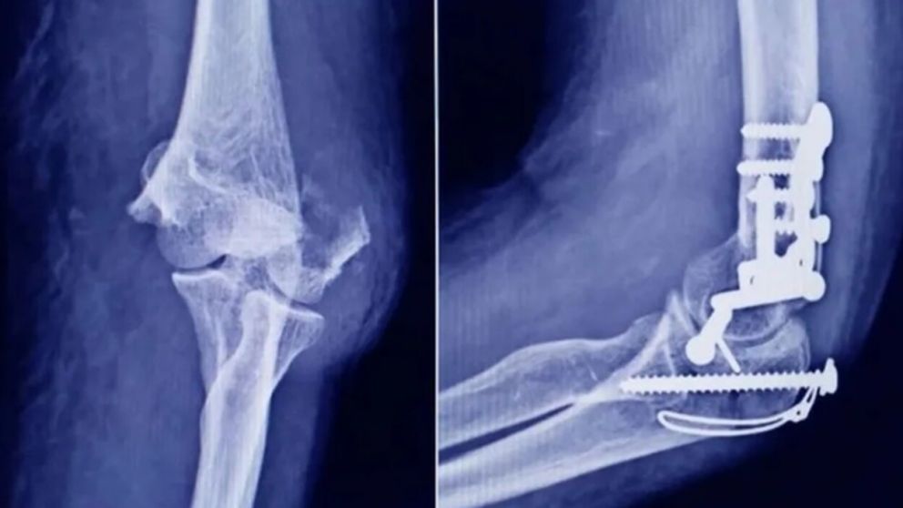 El tornillo es utilizado en intervenciones traumatológicas (Imagen ilustrativa).
