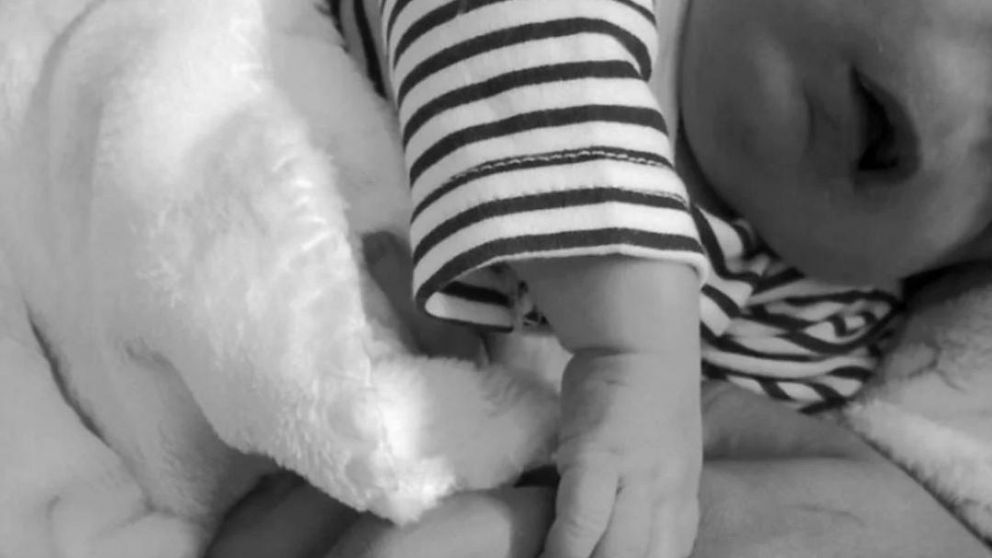 El nene nació sin nariz, ojos y con malformaciones en el cráneo.