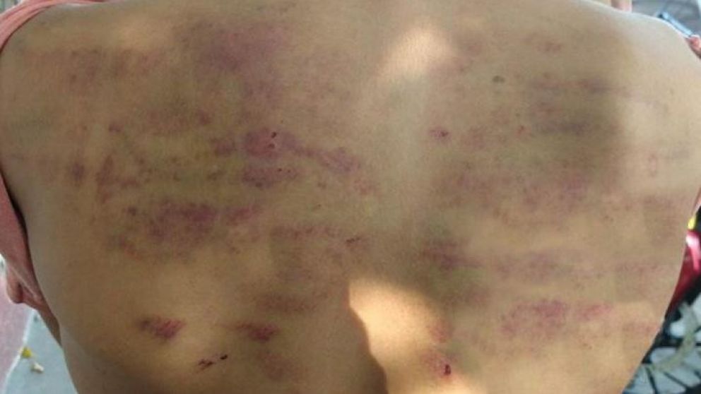 Así tenía la espalda la víctima de maltrato infantil. (Gentileza TNGoya)