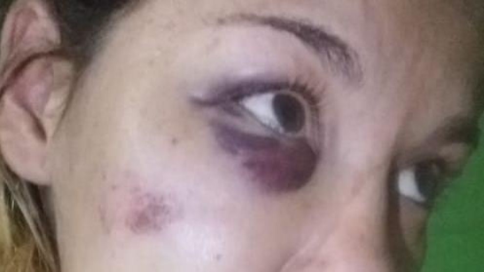 Las huellas del maltrato en el rostro de la joven.