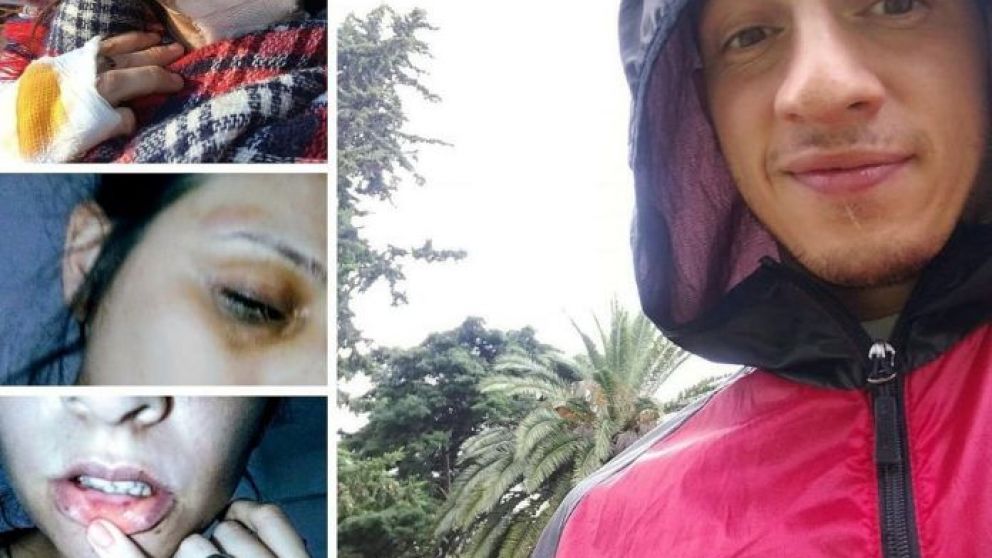 Las marcas de la violencia en el rostro de Melina y su agresor.