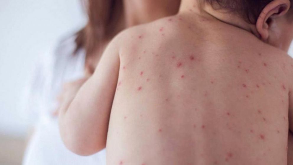 Los niños de entre 12 meses y 4 años deben acreditar una dosis de vacuna triple viral .