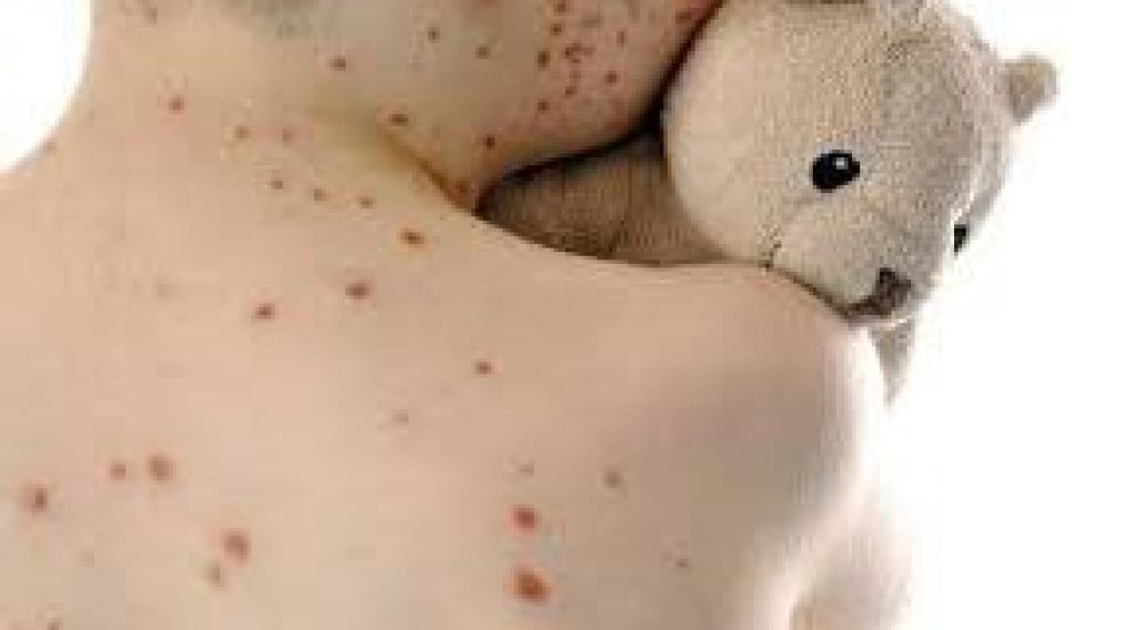 Grupos antivacunas, ¿responsables del brote de sarampión?