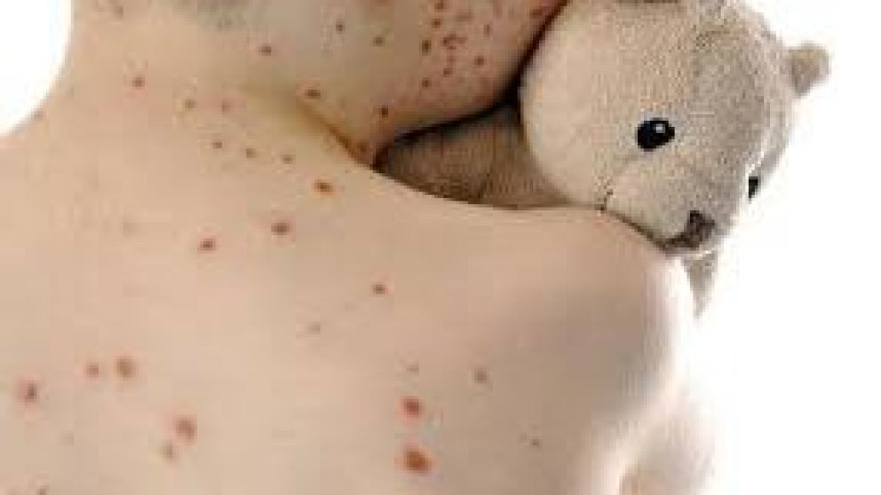 Grupos antivacunas, ¿responsables del brote de sarampión?