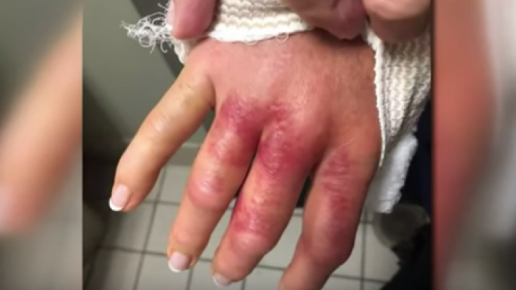La bacteria ingres� al organismo a trav�s de una lesi�n en la piel. 
