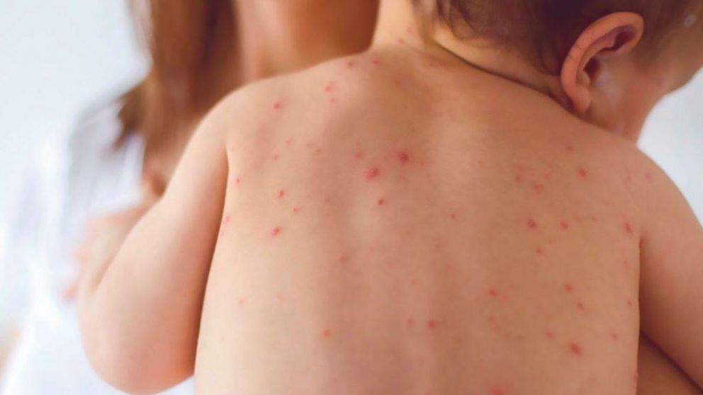 Los bebés, los más vulnerables ante el sarampión.