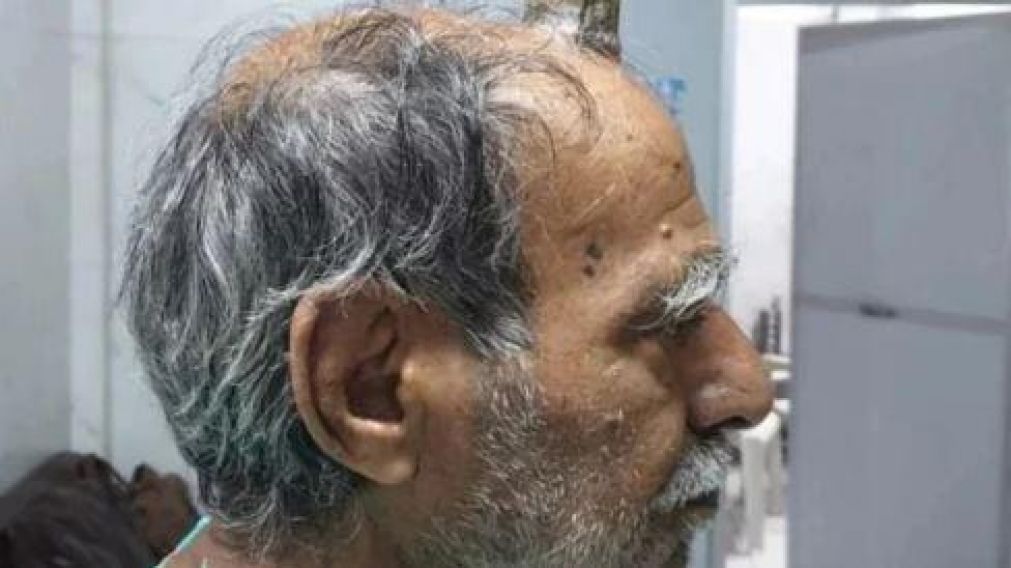 Un hombre se golpeó la cabeza y le comenzó a crecer un “cuerno del diablo” en la cabeza.