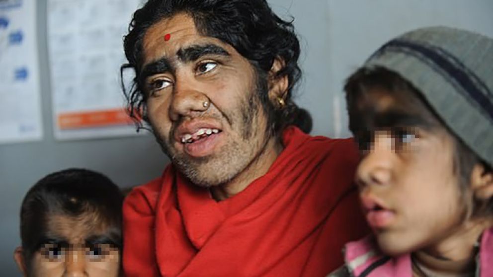 Son pocos los casos que a nivel familiar sufren el "Síndrome del hombre lobo".