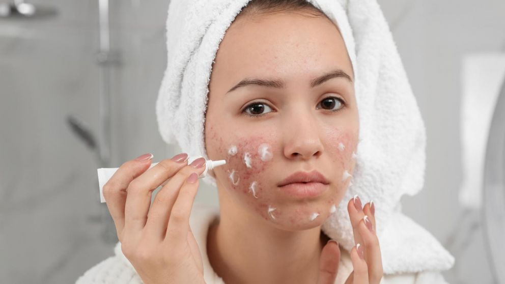 Una crema para el acné es uno de los productos prohibidos por la ANMAT (Imagen ilustrativa).