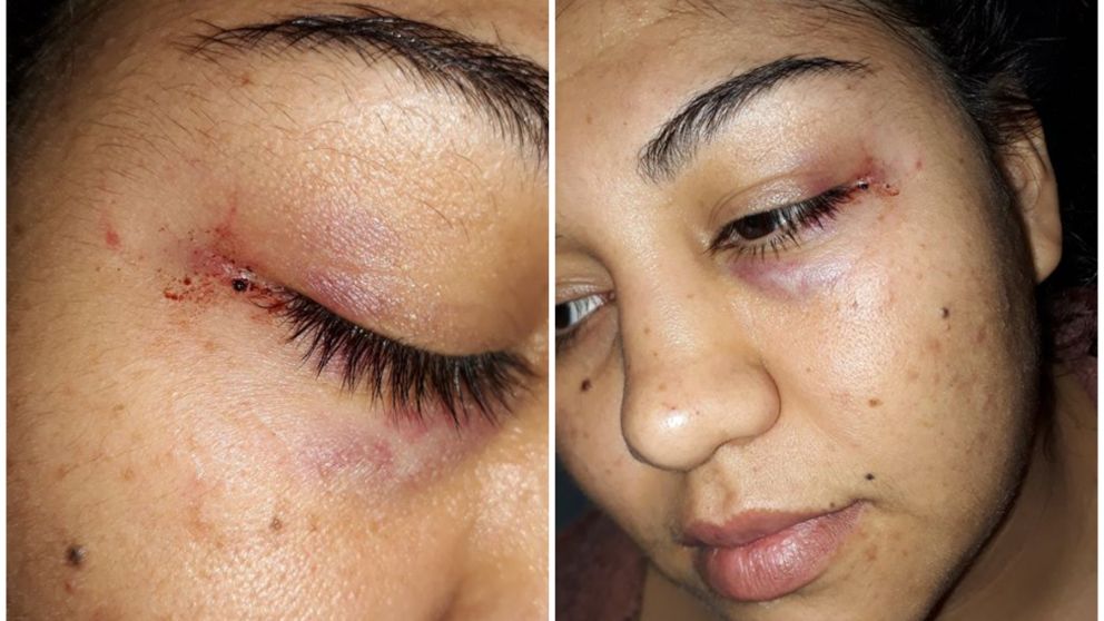 La vecina de 25 años quedó visiblemente lastimada.