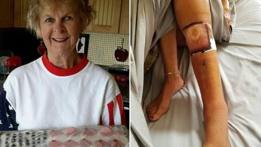 La mujer falleció luego de que la bacteria ingresara a su cuerpo por una herida (Facebook).