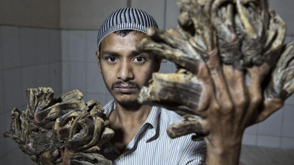 El “hombre árbol” volvió al hospital porque necesita más cirugías.