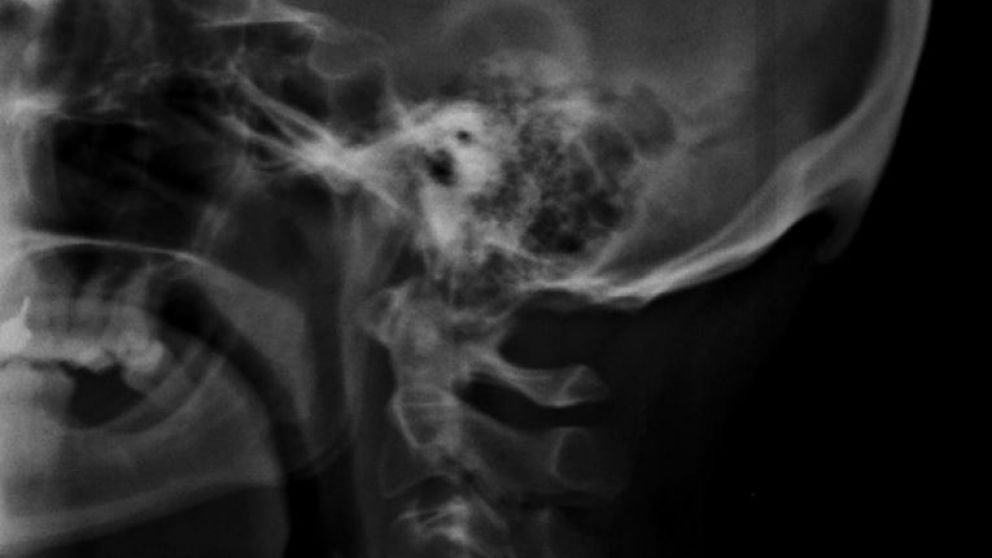 Se trata de un�hueso en forma de pico, llamado protuberancia occipital externa (Twitter). 