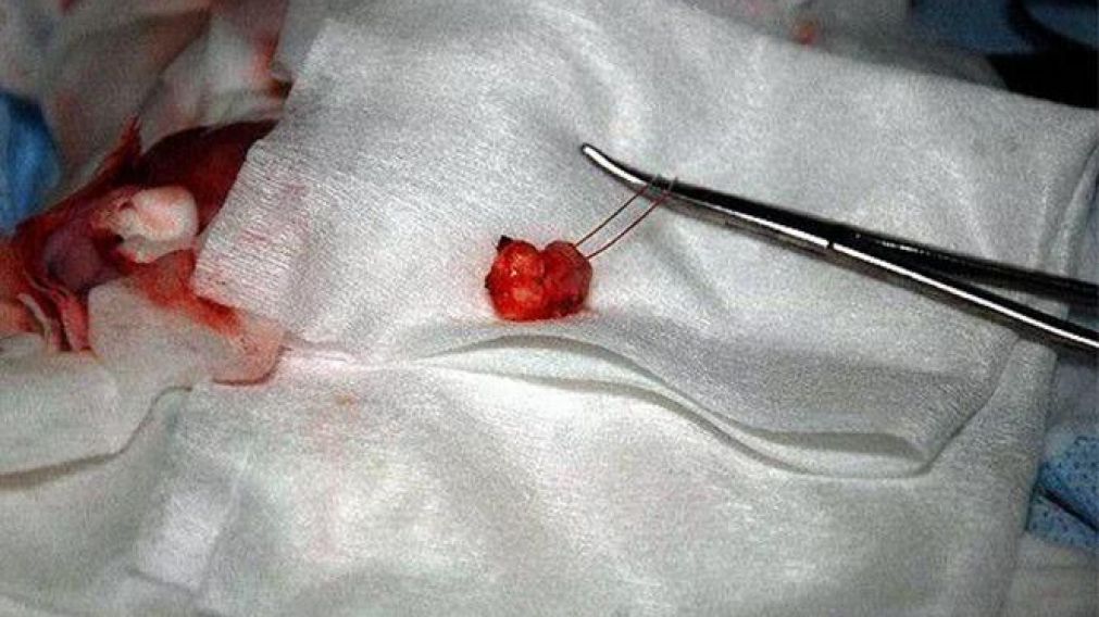 Le faltaba una muela en la boca y se la encontraron dentro de un testículo