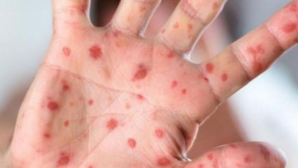 Un hermano del infectado también presenta una erupción compatible con la enfermedad.