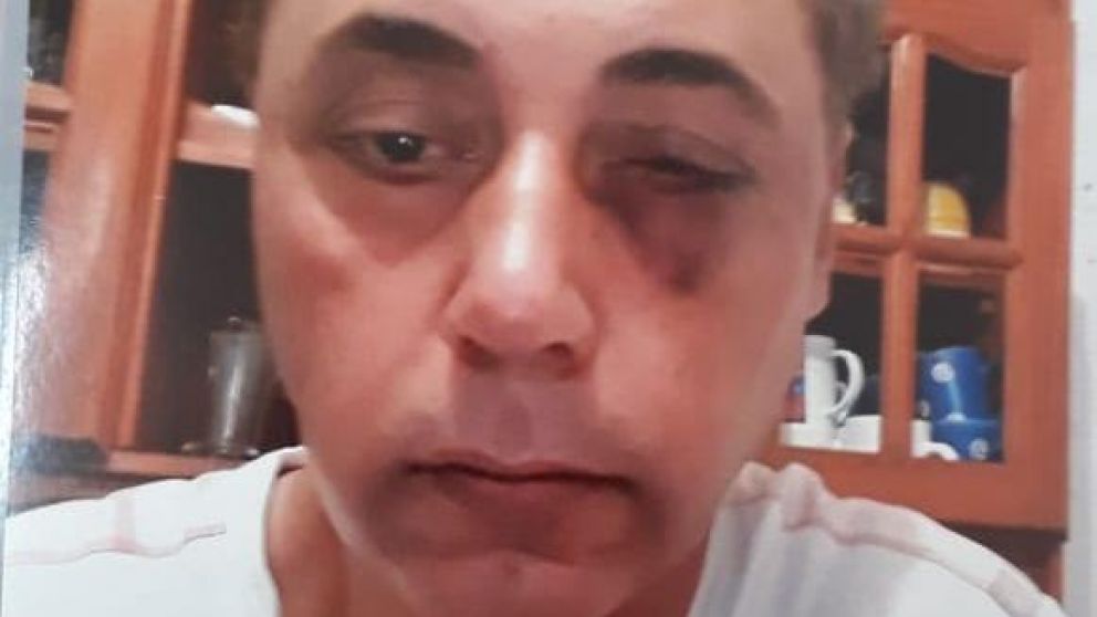 Marcelo Saucedo y las huellas de los golpes que recibió.