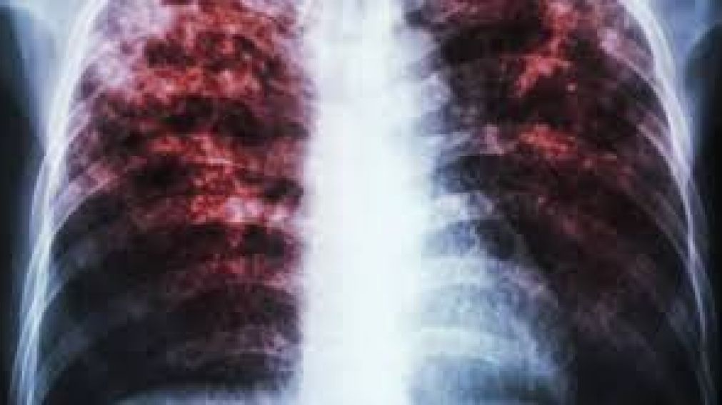 Para prevenir la tuberculosis hay que vacunarse. (Imagen ilustrativa)