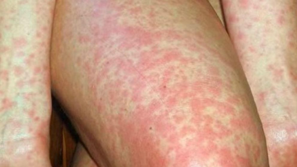 El rosarino habría tenido contacto con un turista ruso que tuvo esa enfermedad. (Imagen ilustrativa)