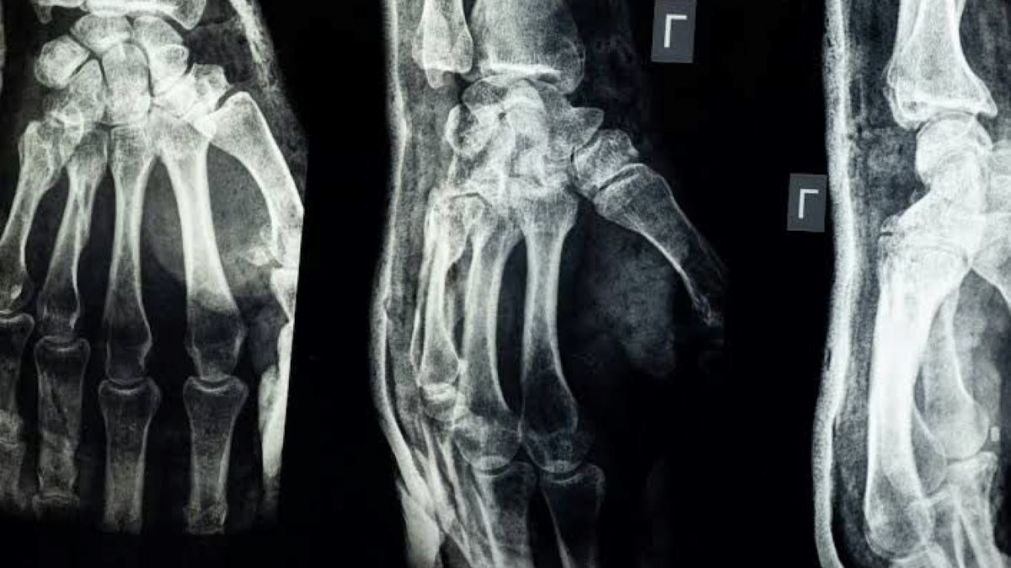 “Bone-02” fue creado por investigadores de la Universidad de Zhejiang, en China.