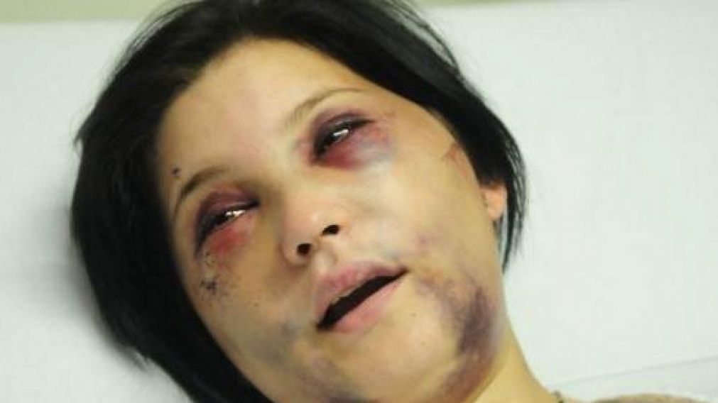 As� qued� la joven, desfigurada a golpes por el anestesista. 