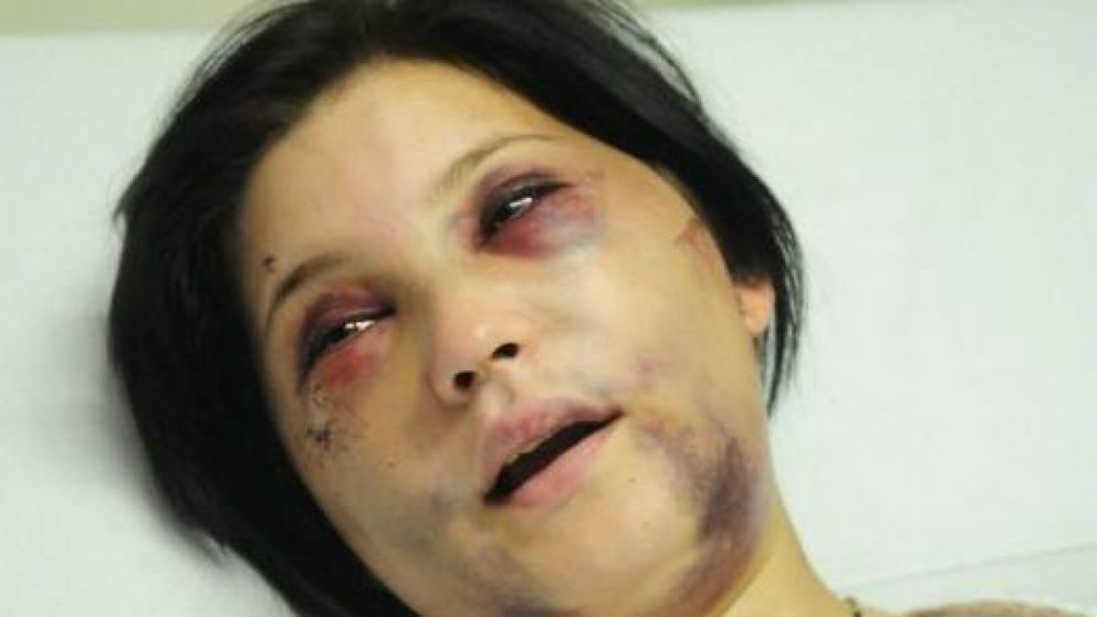 Así quedó la joven, desfigurada a golpes por el anestesista.