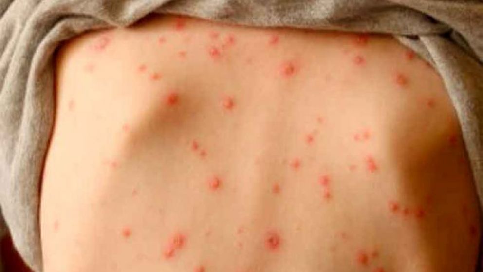 El sarampión preocupa en todo el mundo.