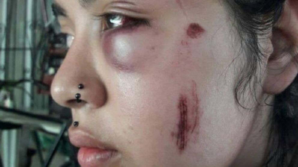 Así quedó uno de los pómulos de la joven tras la brutal agresión,