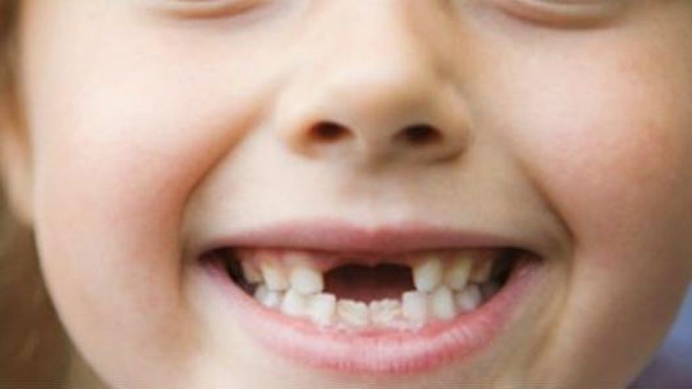 Usó un drone para arrancarle diente flojo a su hija