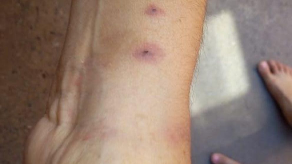 Las marcas en el cuerpo de Sandra Vaquinsay.