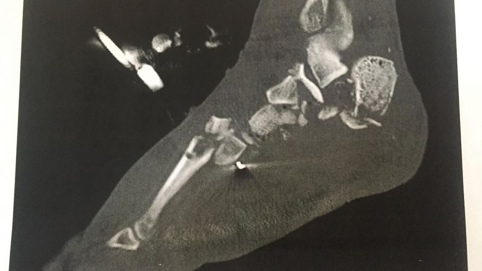 Destruido. Así estaba el pie antes de la disección. (imgur.com)