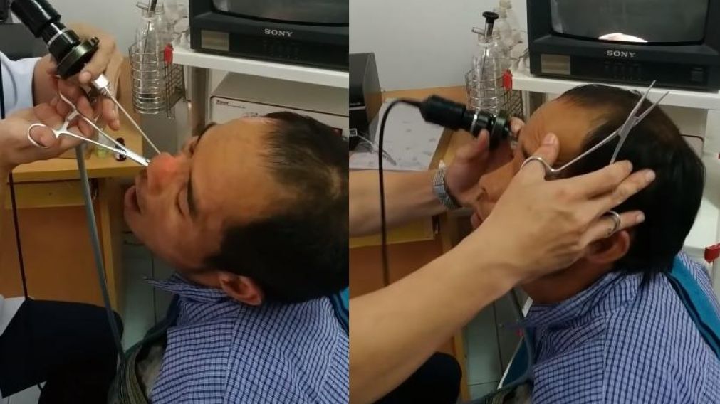 El momento en donde el médico extrae al extraño animal desde los fosas nasales del paciente..