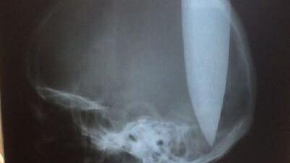 La radiografía muestra la gravedad de la herida.