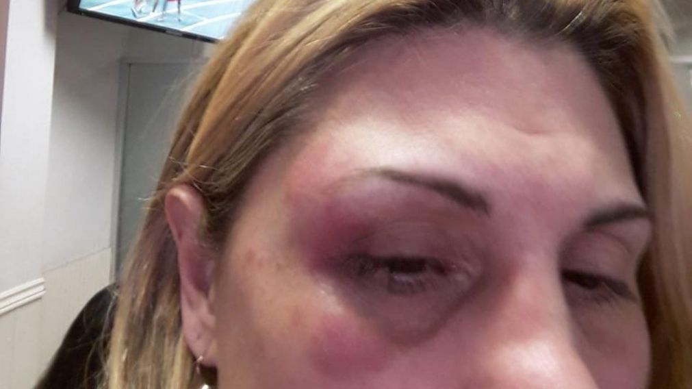 La marca del puñetazo que recibió Mariana en uno de sus ojos.