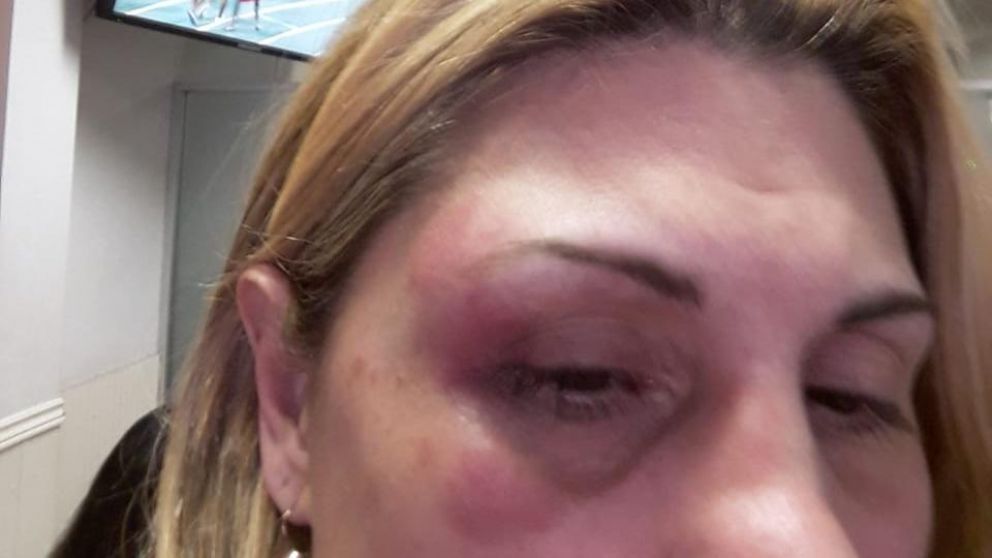 La marca del puñetazo que recibió Mariana en uno de sus ojos.