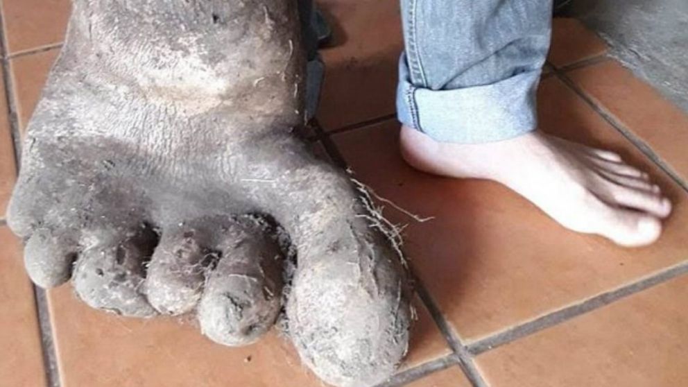 La impactante comparación entre una extremidad y la otra.