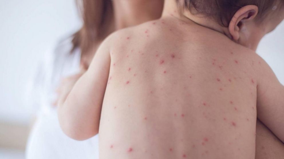 Los afectados son un varón de 5 meses y una nena de 6 meses.