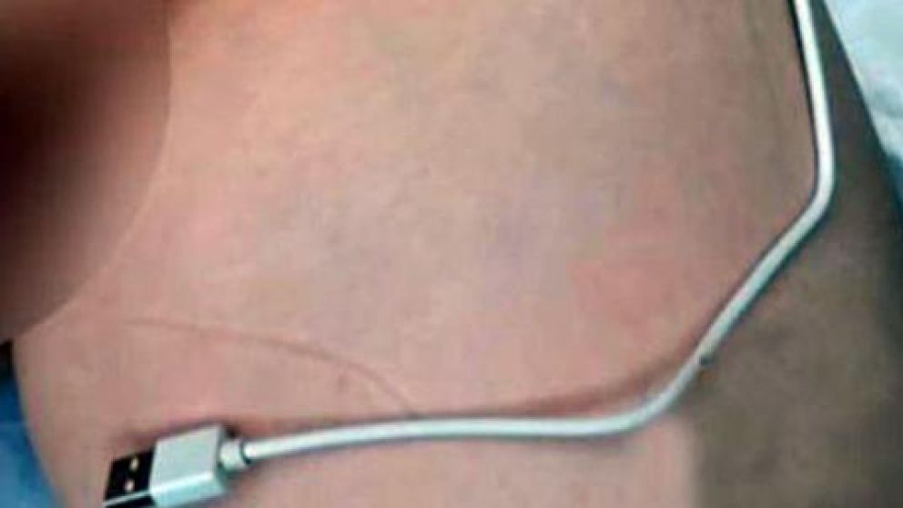 Nene "curioso" se metió cable USB en el pene: acabó en el hospital