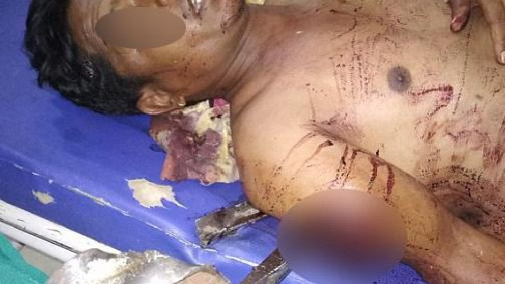 Prajapat sobrevivió más de 5 horas con una enorme barra de hierro atravesada en su cuerpo.