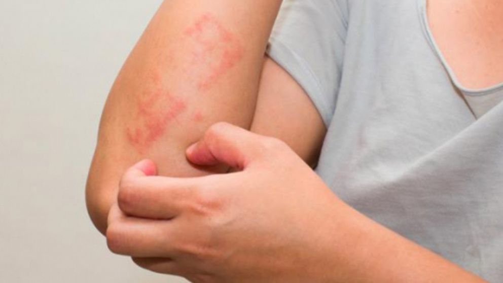 Los pacientes con psiriosis no sufren pero tienen molestias.