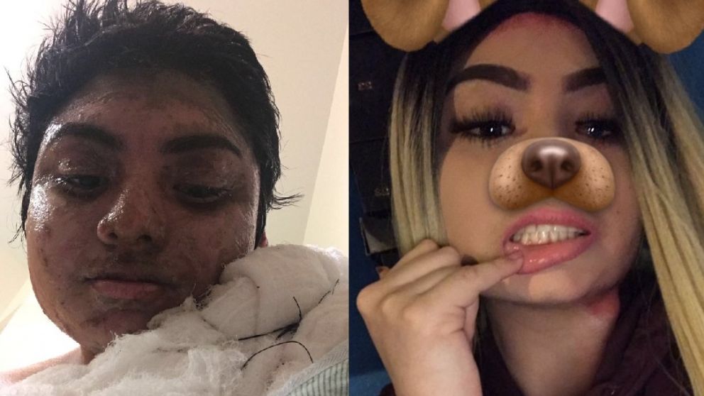 Así quedó la cara de la joven tras la agresión del hombre que le lanzó ácido.