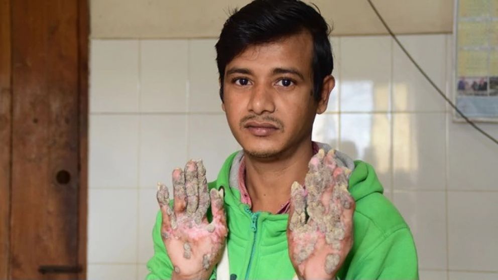 Después de 16 operaciones, las verrugas volvieron a aparecer en sus manos.