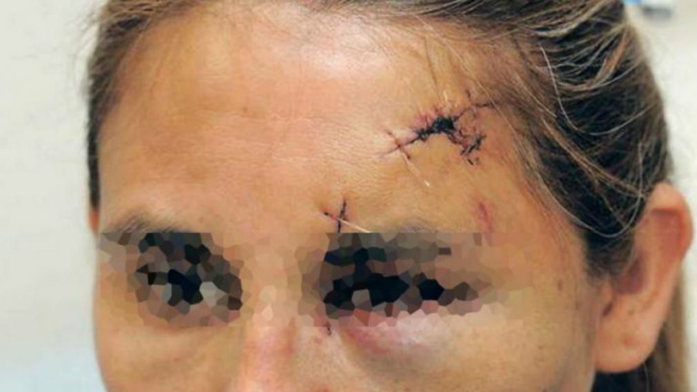 Concubino le partió la cabeza con sartén pero ella no quiere que lo metan preso