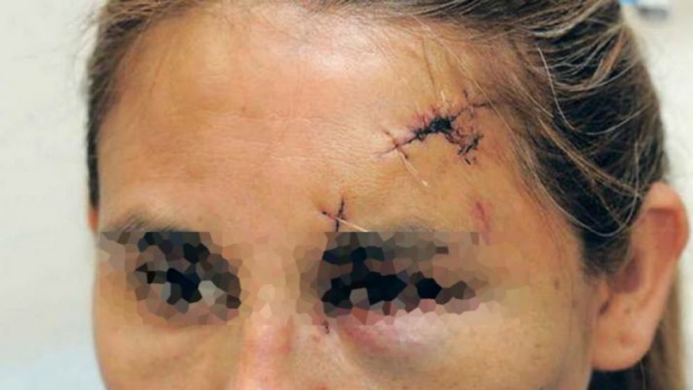 Concubino le partió la cabeza con sartén pero ella no quiere que lo metan preso