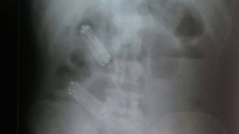 La radiografía con los teléfonos en su sistema (G1).