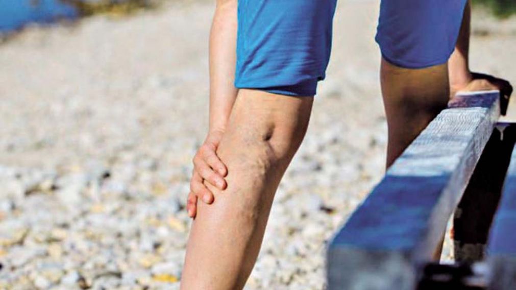 V�RICES. Las padecen tanto hombres como mujeres.
